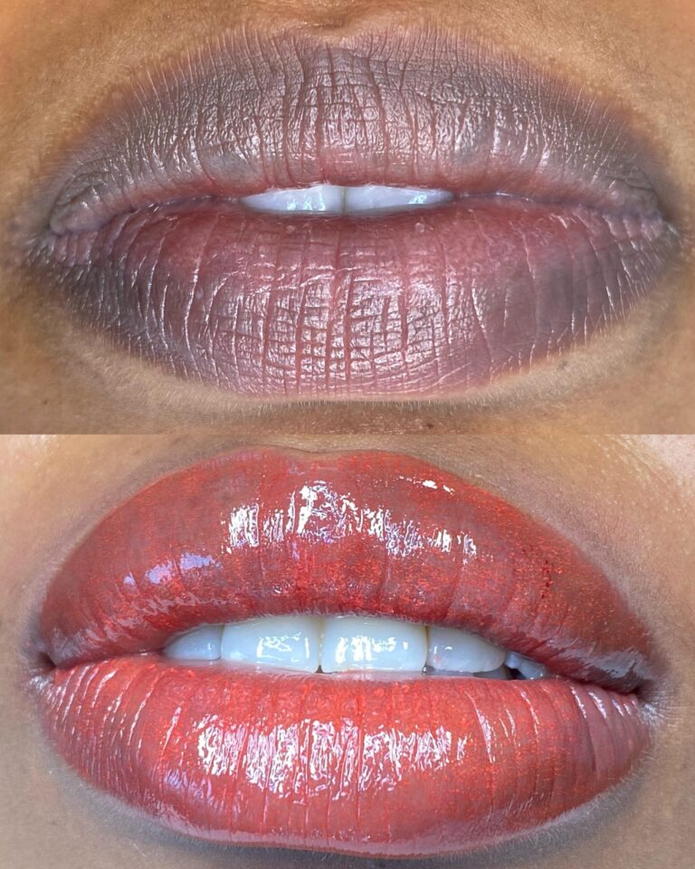 Lip neutralization The Abram