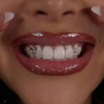 Tooth Gems
