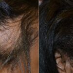 Minoxidil: Hair Loss Treatment