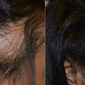 Minoxidil: Hair Loss Treatment
