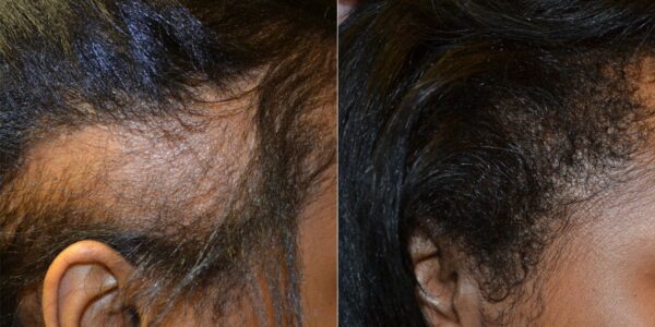 Minoxidil: Hair Loss Treatment