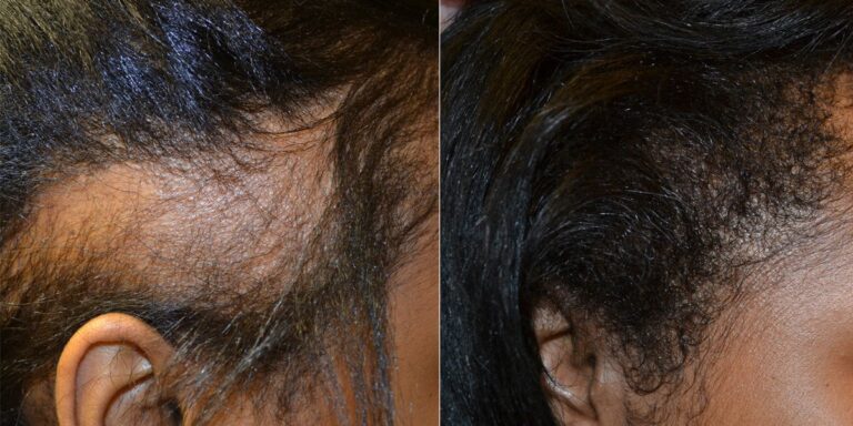 Minoxidil: Hair Loss Treatment