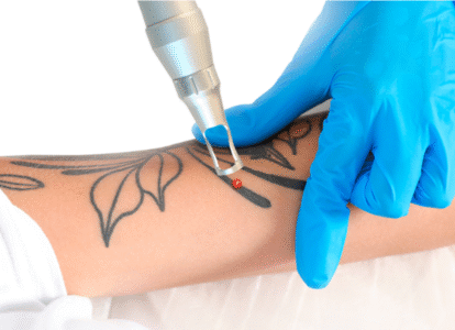 Tattoo Removal (Pico Sure Laser)