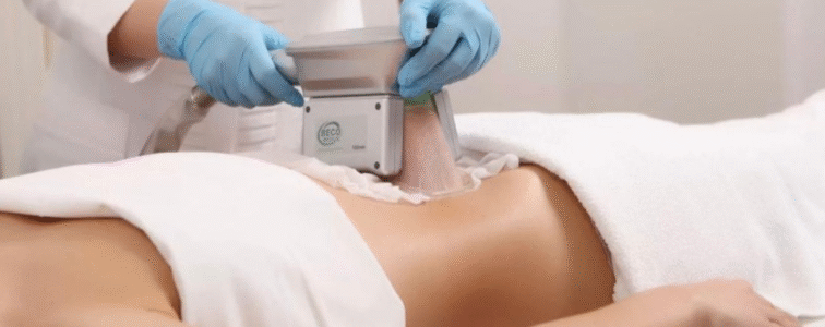 Cryolipolysis