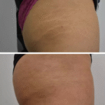 Carbon Laser Stretchmark Removal