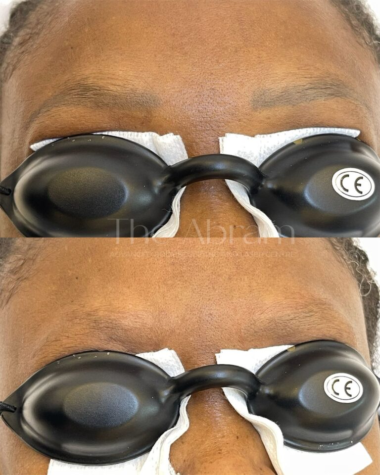 Eyebrow Tattoo/Microblading Removal