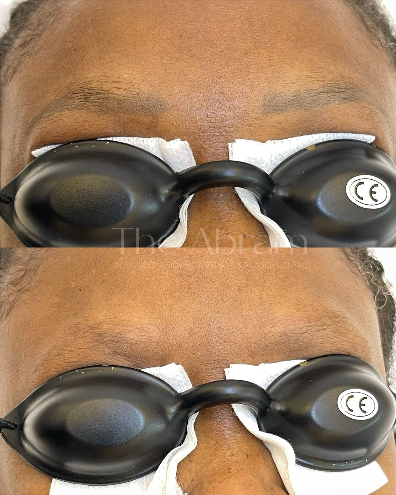 Eyebrow Tattoo/Microblading Removal