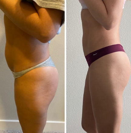 Lipo Shots Before & After