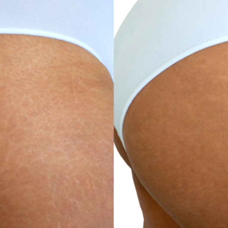 Stretchmark Removal