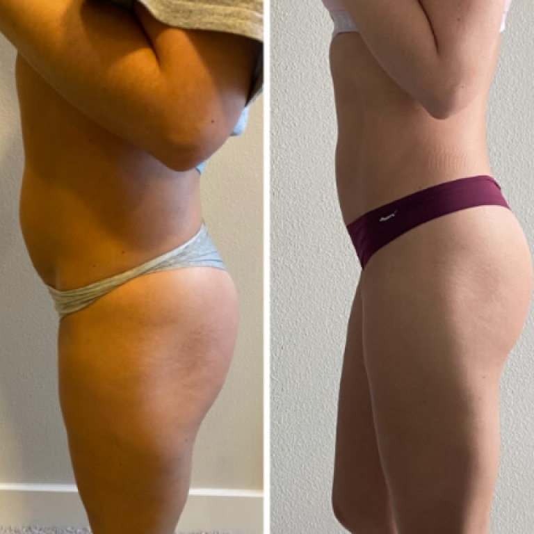 Lipo Shots Before & After