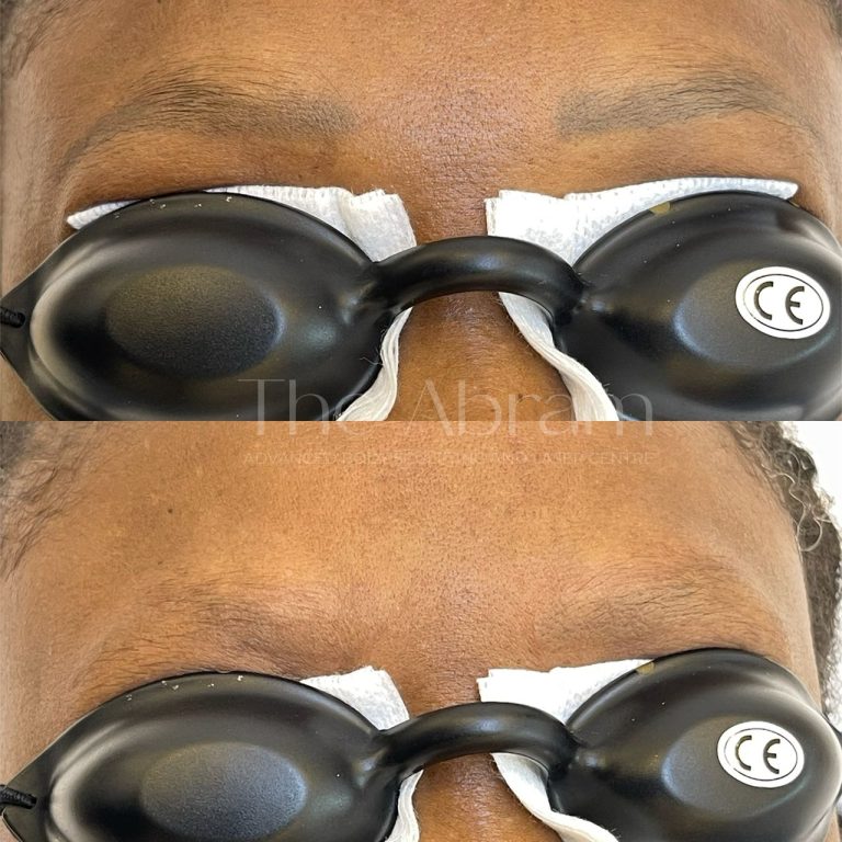 Eyebrow Tattoo/Microblading Removal